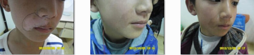 儿童病发治疗图片