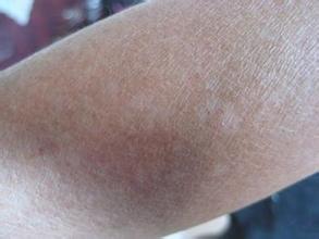 女性白斑患者在治疗中需要注意什么 女性白斑患者在治疗中需要注意什么.jpg