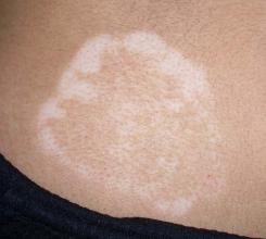 得了白癜风后应该禁食哪些食物呢 得了白癜风后应该禁食哪些食物呢.jpg