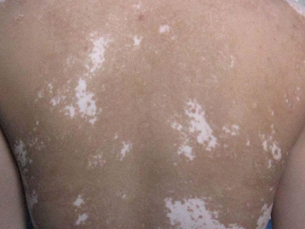 孕期白癜风患者如何护理好呢 孕期白癜风患者如何护理好呢.jpg