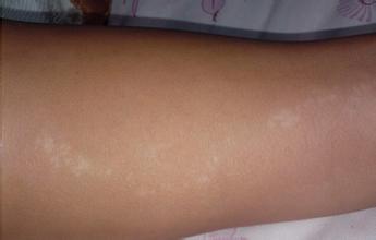 儿童白癜风心理治疗有效吗 儿童白癜风心理治疗有效吗.jpg