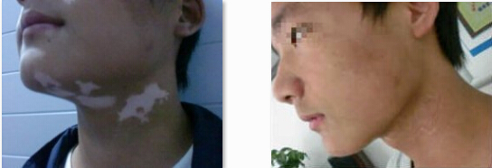 老年白癜风图片