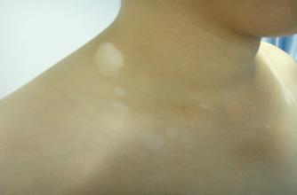 颈部的白癜风有哪些医治方法 颈部的白癜风有哪些医治方法.jpg