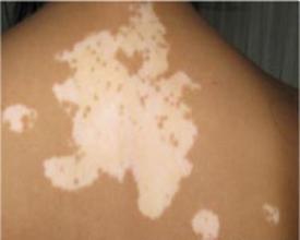 男性白癜风怎么治疗效果好 男性白癜风怎么治疗效果好.jpg